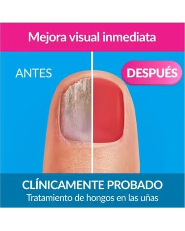 EXCILOR FORTE COLOR RED NAGELLACK NAGELPILZ BEHANDLUNG 30ML